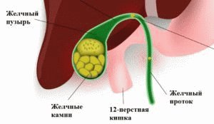 Камни в желчном пузыре и протоках