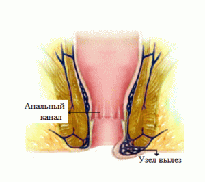 Тромбоз геморроидальных вен