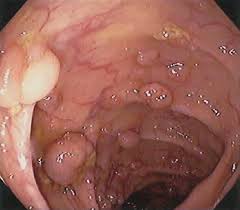 Полипоз ободочной кишки