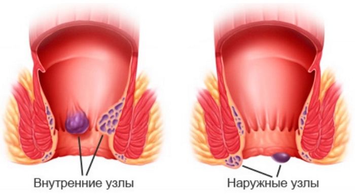 Геморрой не проходит