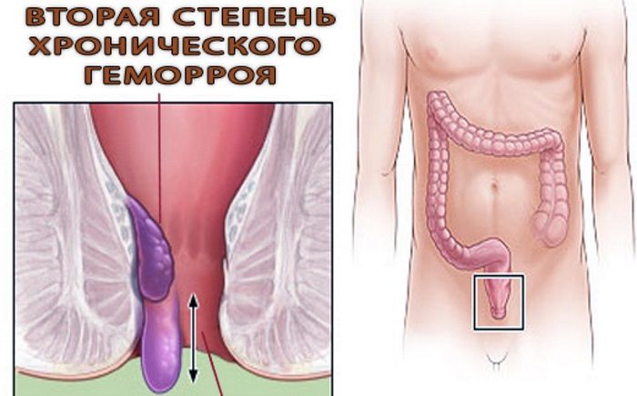 Лечение хронического геморроя 2 стадии