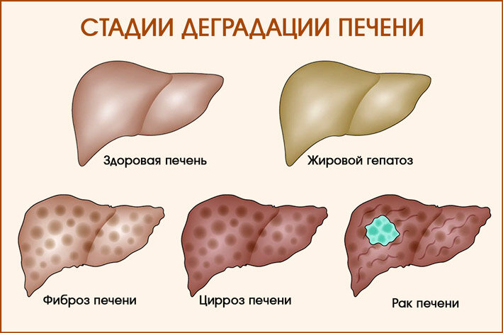 Терминальная стадия печени. Стадии поражения цирроза печени. Цирроз печени 3-4 стадия симптомы.