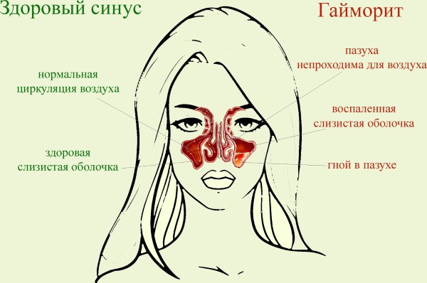 Зеленые сопли у взрослого. Лечение антибиотиками, народными средствами, причины