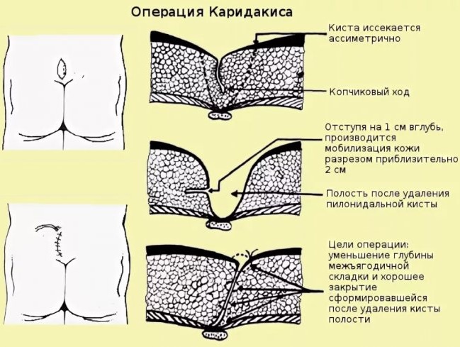 Эпителиальный копчиковый ход (ЭКХ). Фото, чем снять боль, операция, лечение