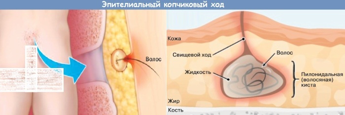 Эпителиальный копчиковый ход (ЭКХ). Фото, чем снять боль, операция, лечение