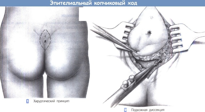 Эпителиальный копчиковый ход (ЭКХ). Фото, чем снять боль, операция, лечение