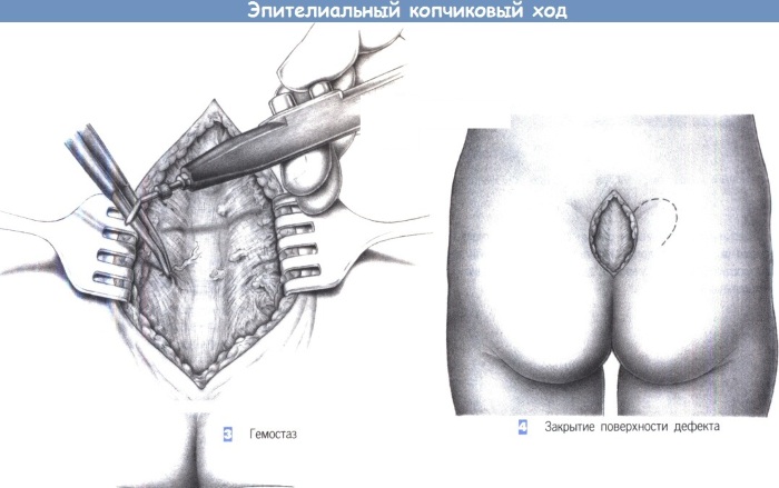 Эпителиальный копчиковый ход (ЭКХ). Фото, чем снять боль, операция, лечение