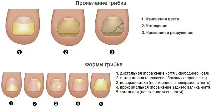 Грибок ногтей на ногах: Как выглядит. Симптомы, лечение препаратами, народными средствами