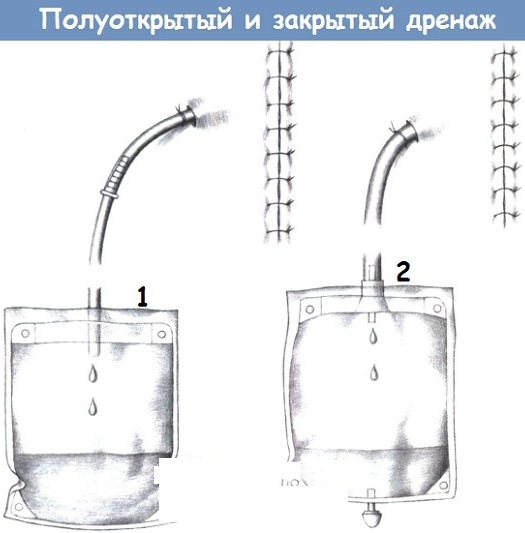 Дренажи в хирургии. Виды, назначение, характеристики