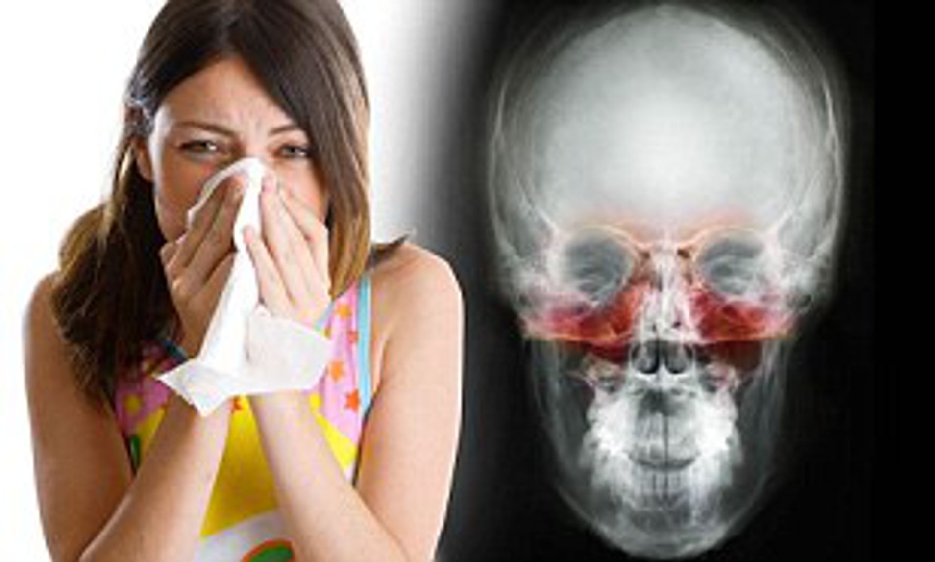 Причины заболевания носа. Острый ринит хронический синусит. Синусит гайморит фронтит.