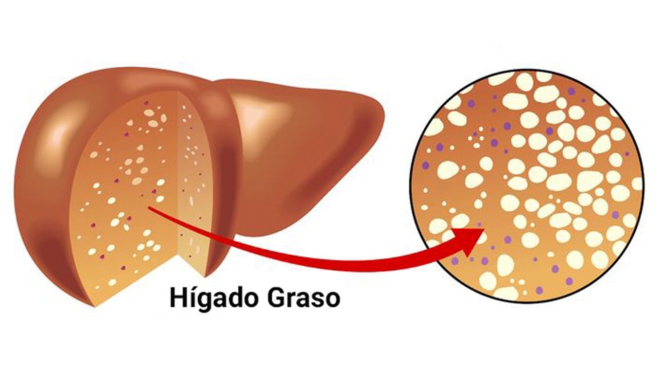Изменения клеток печени. Жировой гепатоз (стеатоз) печени. Стеатоз печени дистрофия. Жировая дистрофия печени (стеатоз печени). Гепатоз жировой гепатоз.