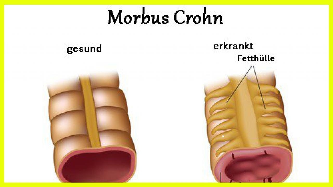 Болезнь крона что это такое. Болезни кротона.