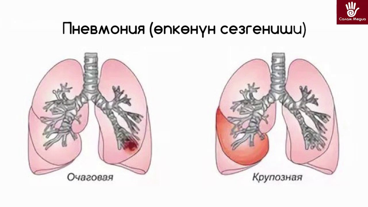 Отличие пневмонии. Крупозная и очаговая пневмония. Крупозная пневмония и очаговая пневмония. Крупозная долевая пневмония. Крупозная пневмония вид воспаления.