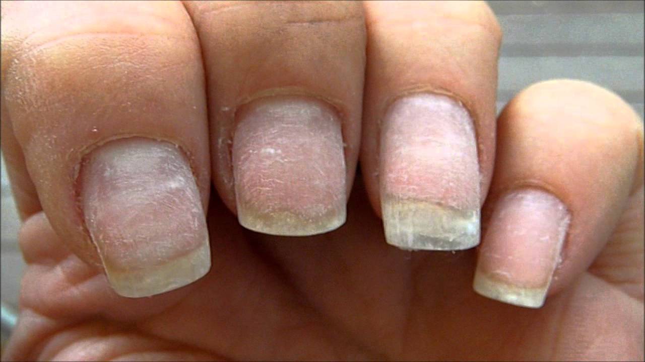 Ногти после геля стали тонкие. Термический онихолизис. Ногти после снятия гель лака.