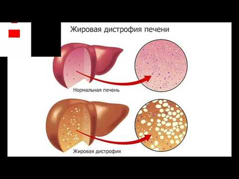 Печень при беременности. Острая дистрофия печени. Острая жировая дистрофия печени. Острый жировой гепатоз. Жировой гепатоз беременных.