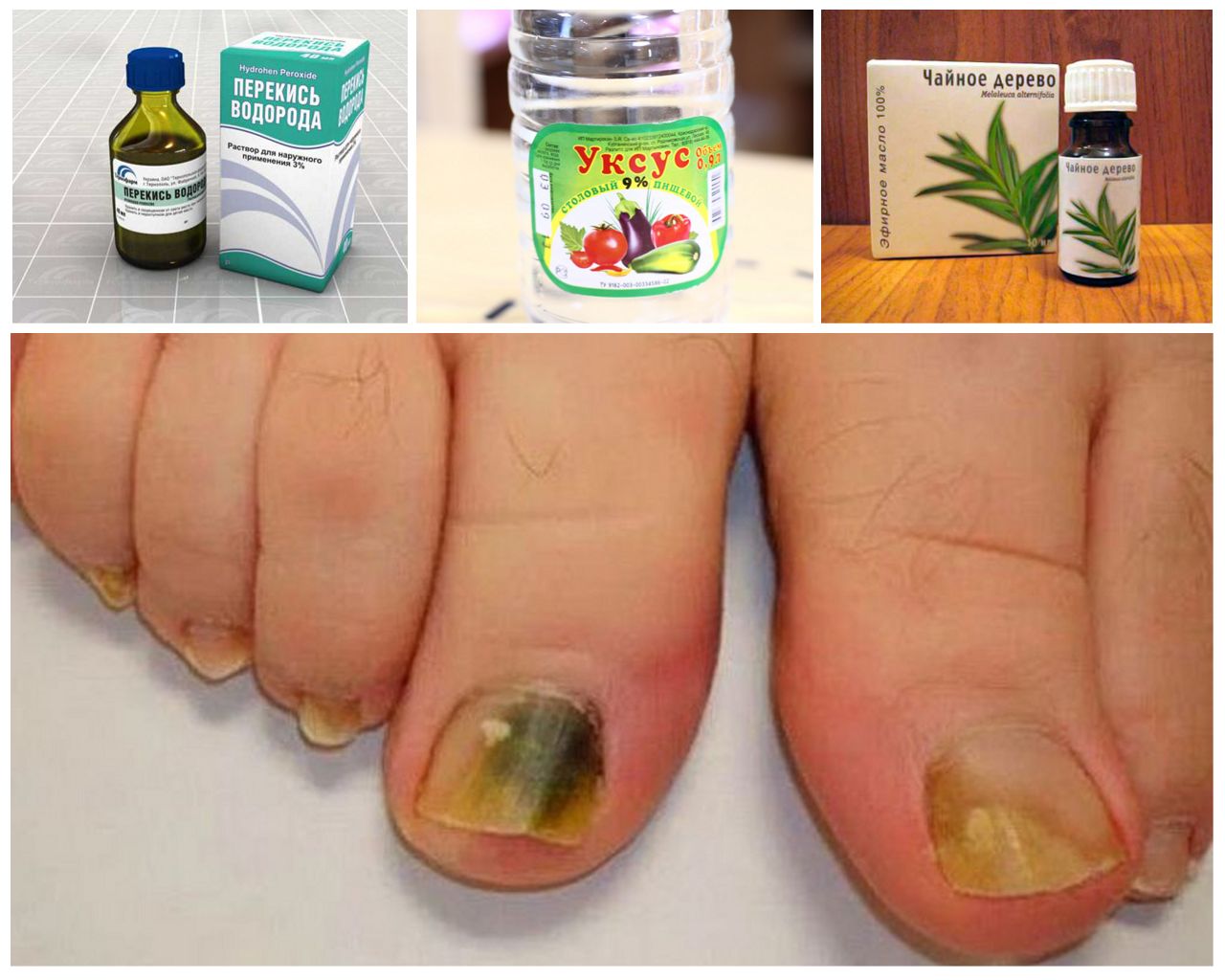 Народное лечение грибок ногтей Как быстро вылечить грибок