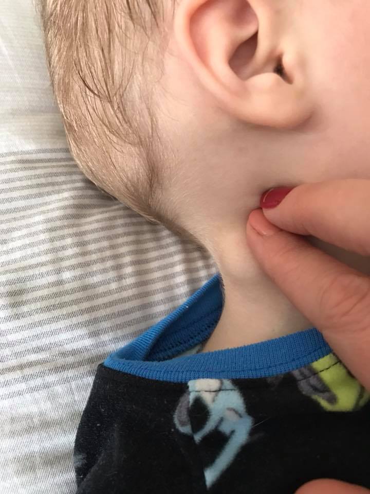 Температура и лимфоузлы на шее у ребенка. Поднижнечелюстной лимфаденит. Воспаленные лимфоузлы за ухом.