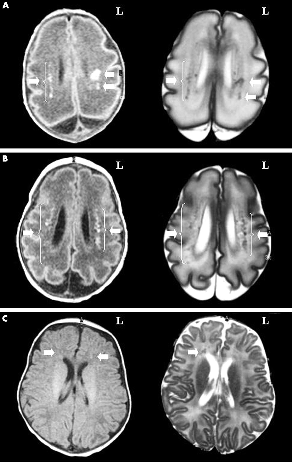 Мозг новорожденного масса. Здоровый мозг новорожденного. Нейросонография головного мозга. УЗИ головы новорожденного.