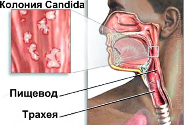 молочница пищевода