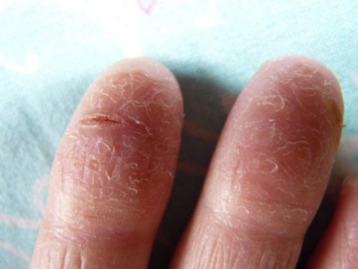 симптомы шелушения кончиков пальцев