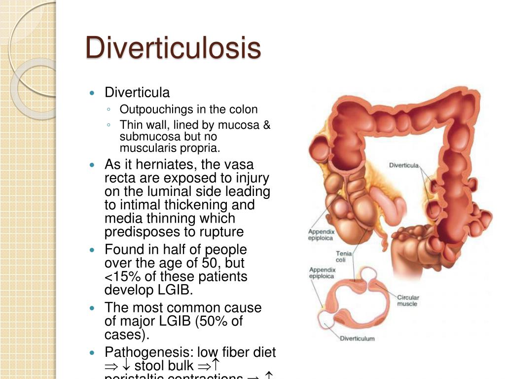 Dieta diverticulosis