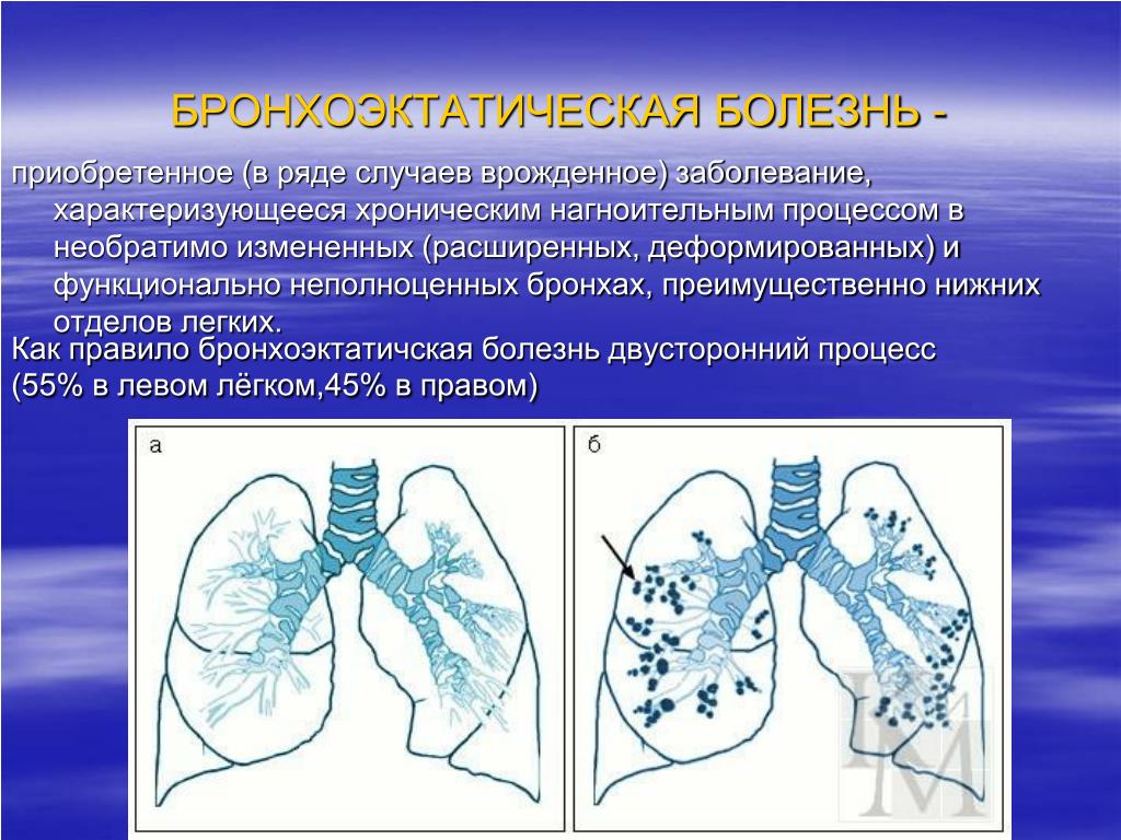 Бронхоэктазы нижней доли