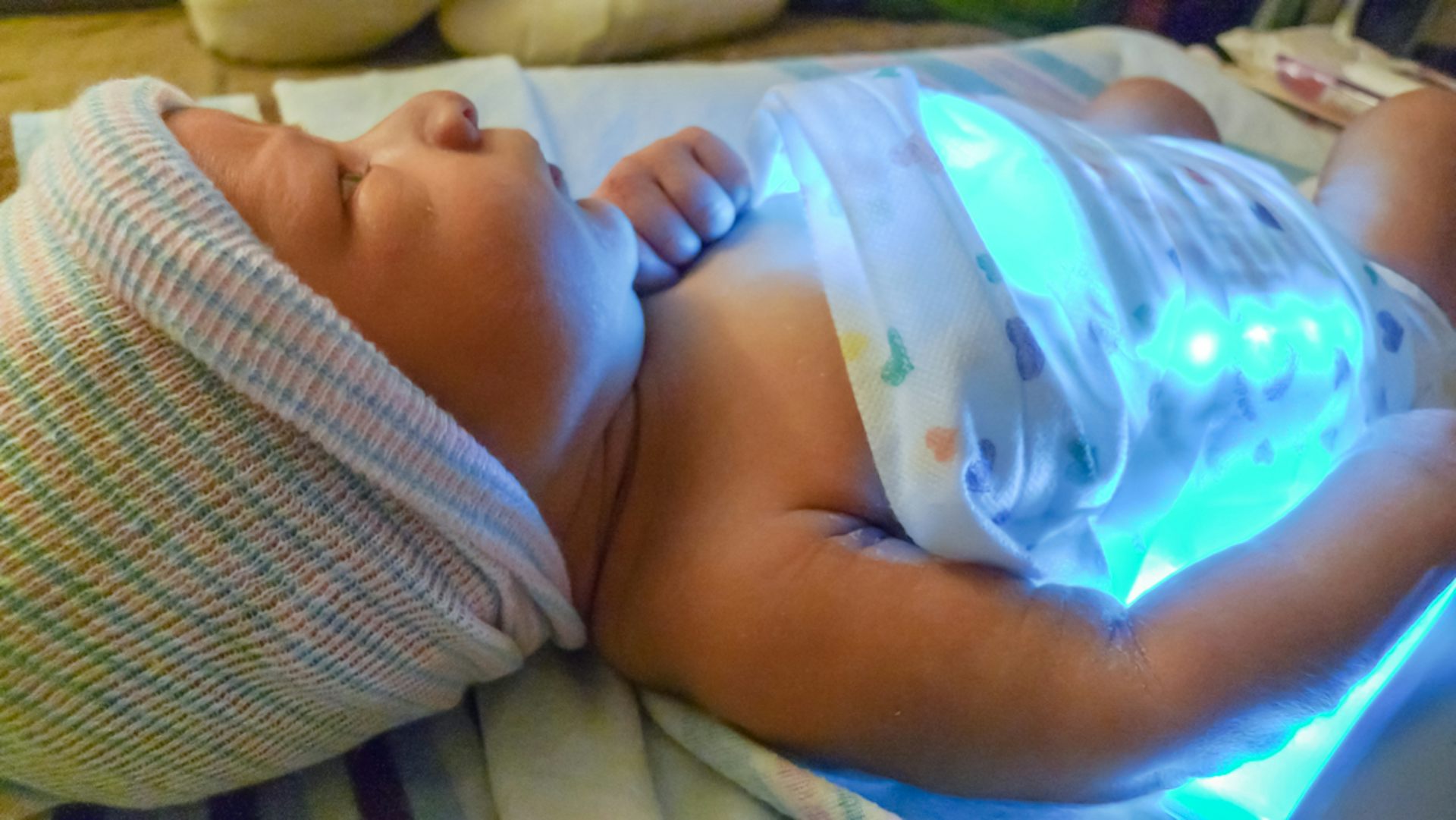 Увеличена печень у новорожденного. Желтуха у ребенка новорожденного. Фототерапия для новорожденных. Желтушка у новорожденных фото.