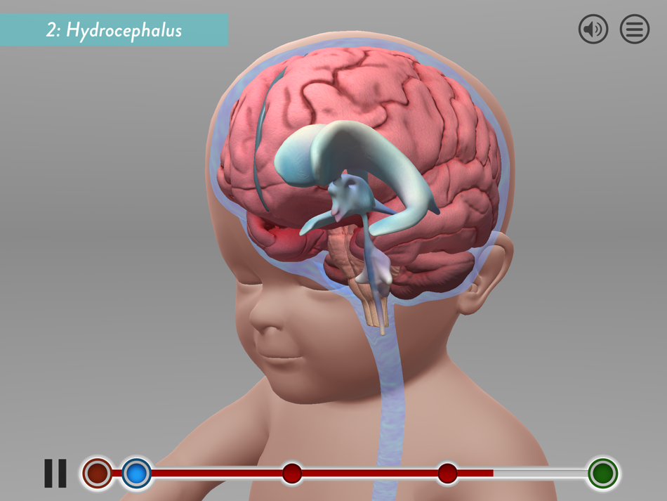 Мозг ребенка видео. Гидроцефалия головного мозга. Внутричерепное давление.