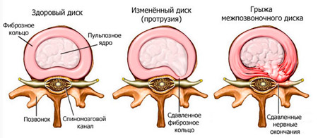 Межпозвонковая грыжа