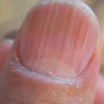 ridges in fingernails
