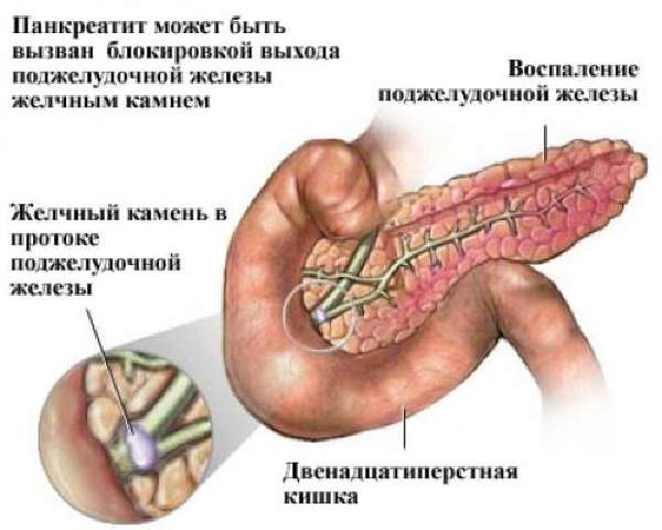 Панкреатит от блокировки хода камнем