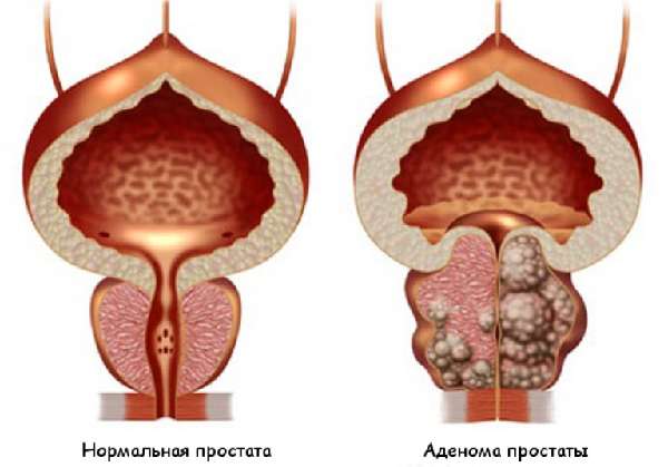 Аденома предстательной железы