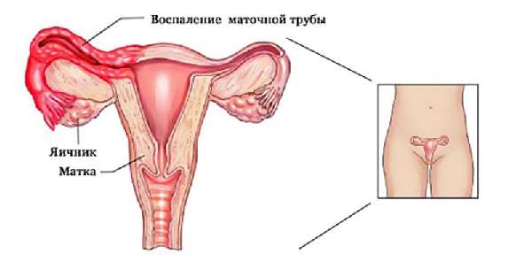 Аднексит