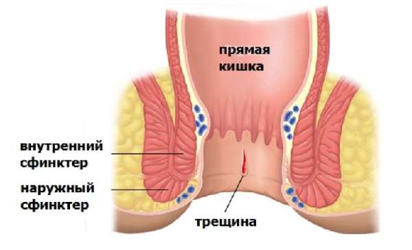 Трещина в анальном отверстии