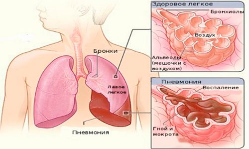 Что такое пневмония?