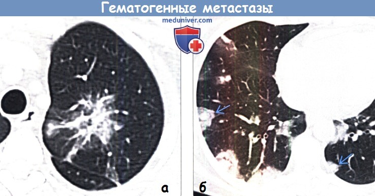 Метастазы в легких. Гематогенные метастазы в легких на кт. Гематогенные метастазы на кт. Метастазы меланомы в легкие на кт.