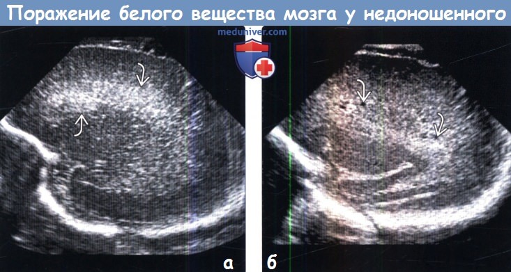 Повышена эхогенность у плода. Туберозный склероз головного мозга у детей на УЗИ. Нейросонография.