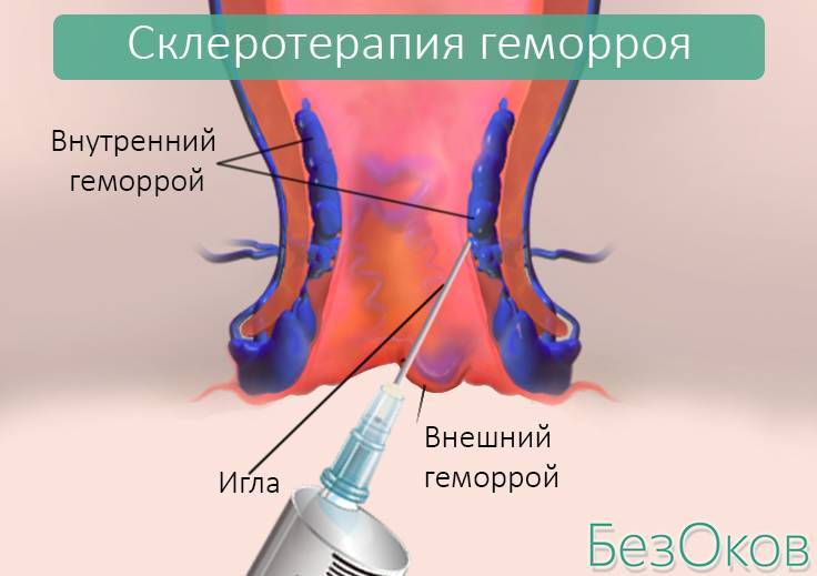 Проктолог удаление геморроя