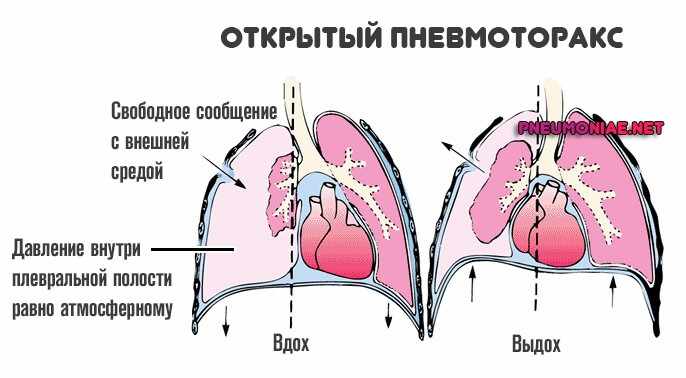 Открытый пневмоторакс. Пневмоторакс открытый закрытый клапанный. Механизм развития открытого пневмоторакса. Пневмоторакс физиология. Пневмоторакс объективно.