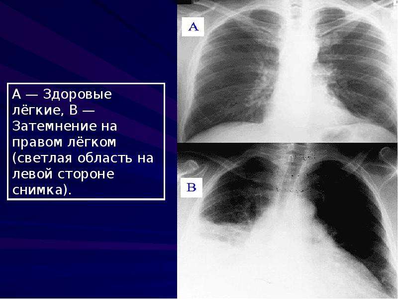 Затемнение в легких на флюорографии что это. Затемнение на снимке легких. Легкие на рентгене затемнение. Потемнение на легких на рентгене.