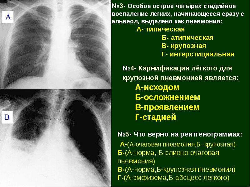 Чем отличается пневмония от ковида 19. Односторонняя пневмония. Сообщение на тему воспаление лёгких. Острое воспаление легких.