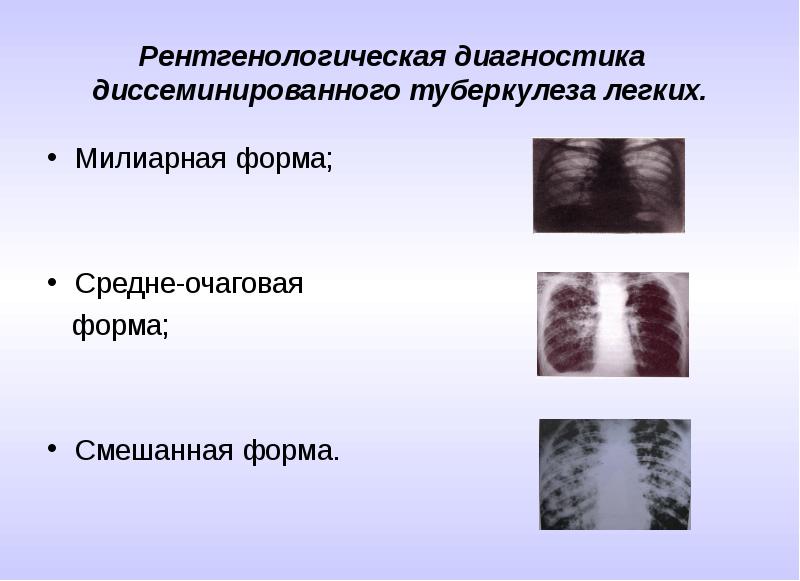 Диссеминированный туберкулез фаза инфильтрации. Милиарный диссеминированный туберкулез рентген. Диссеминированный острый диссеминированный туберкулез. Милиарный и инфильтративный туберкулез. Диссеминированный туберкулез на кт.