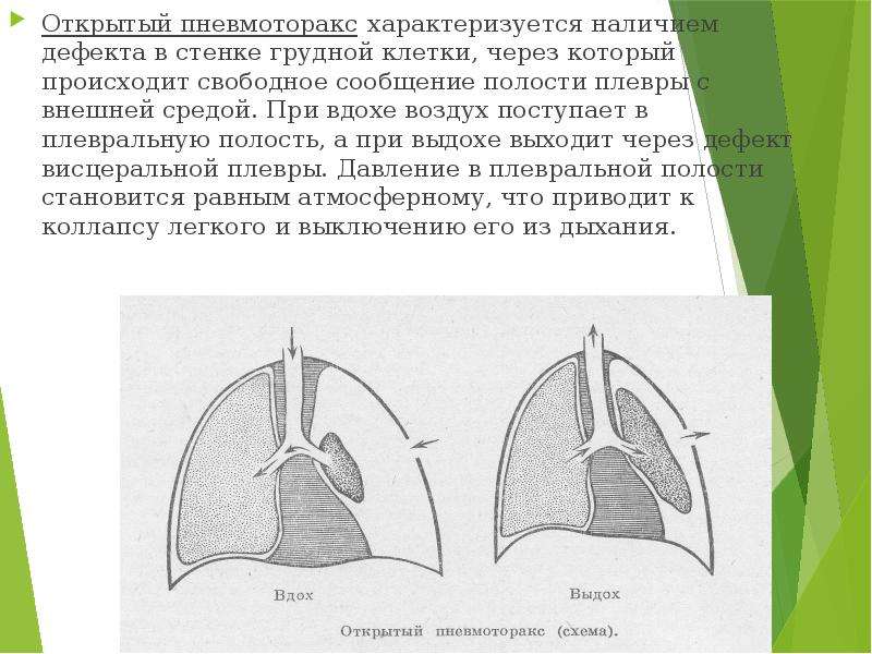 Пневмоторакс что это такое