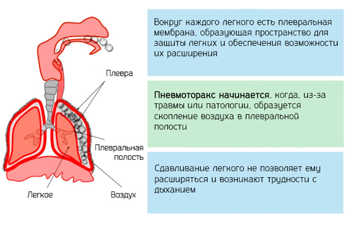 Причины симптоматического пневмоторакса 