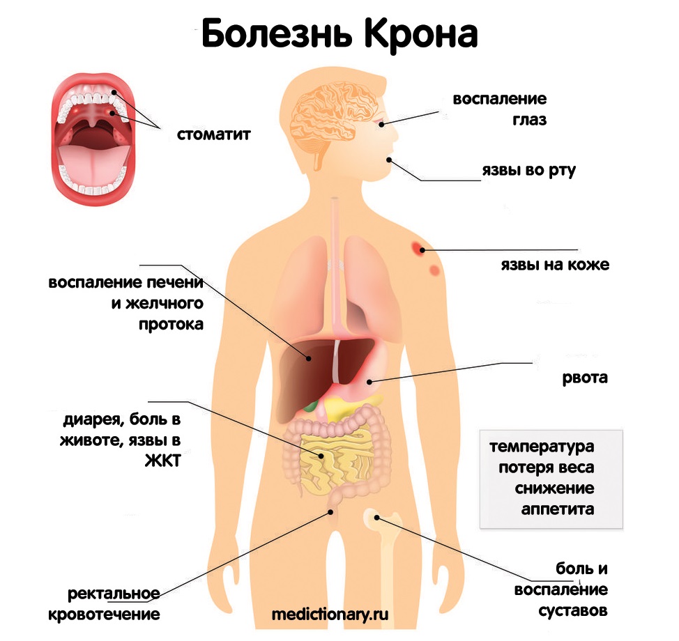 Внекишечные проявления болезни крона