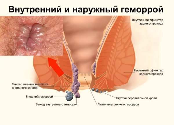 Геморрой у женщин - симптомы и лечение, фото и видео. 