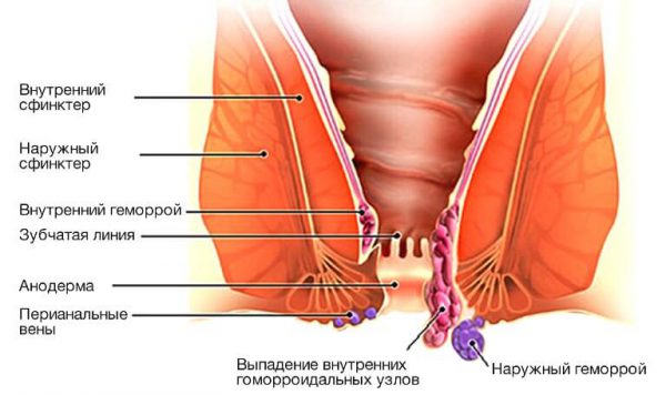 Геморрой у женщин - симптомы и лечение, фото и видео. 