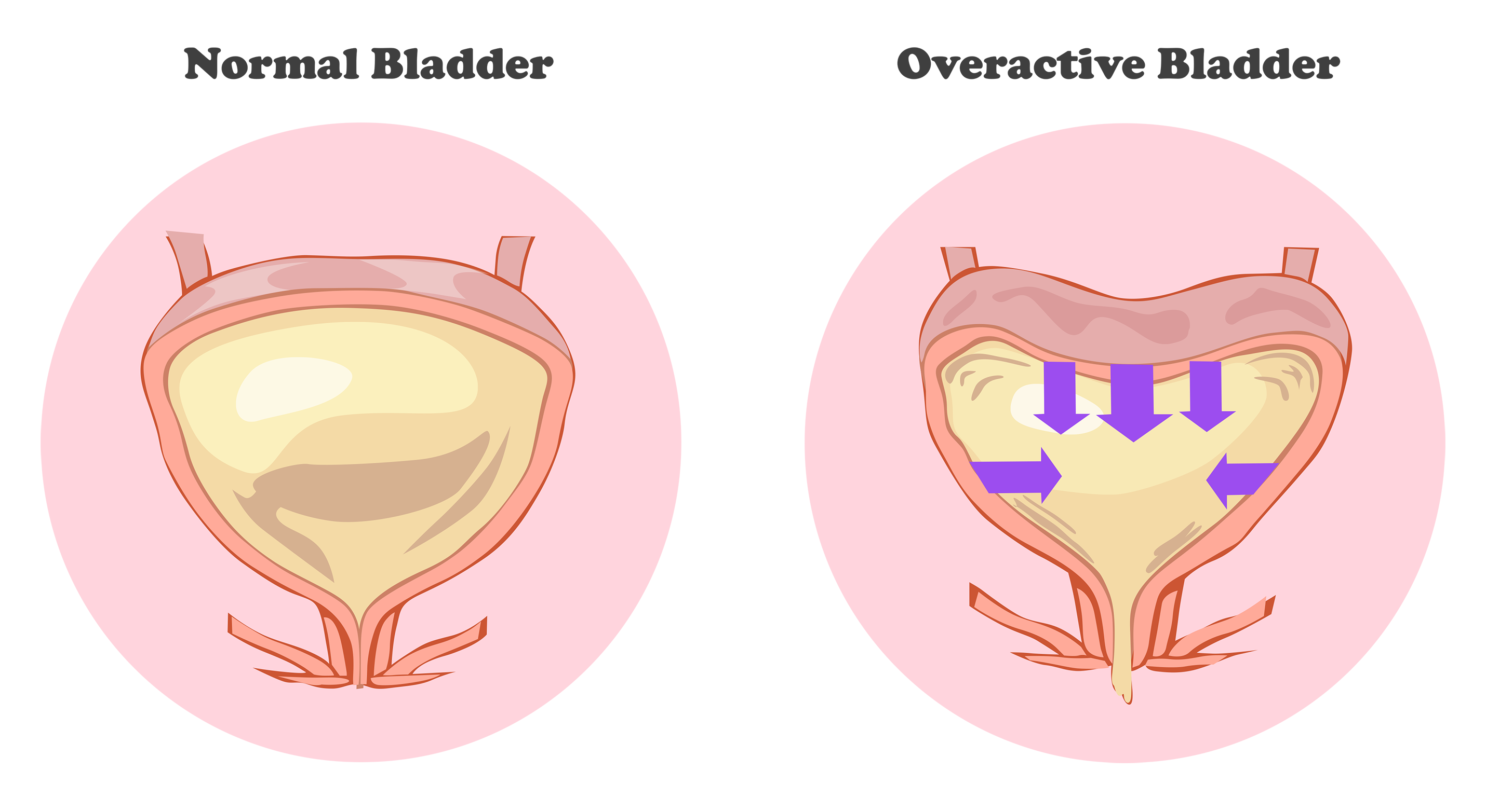 Женский цистит. Overactive bladder. Цистит у женщин. Недержание мочи.