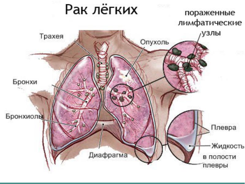 Все про Рак легких: первые симптомы и признаки, стадии, выживаемость