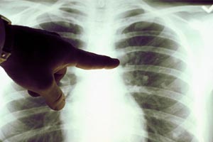 Рентген и флюорография при диагностике рака легких
